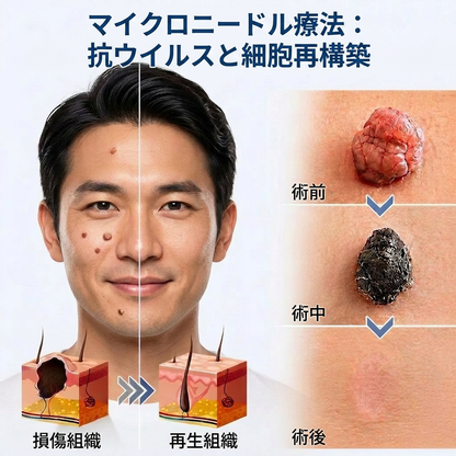 💙PuraCure® 2-in-1 マイクロニードル＆ハイドロコロイドパッチ🧑‍⚕️| 盛り上がったホクロ・ニキビ・扁平イボ・スキンタッグのケアに | シワ・ニキビ跡・肌の色ムラをケア | 目立たない透明パッチ（顔・体用）